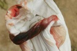 怀孕11周能打胎吗