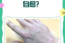 新生儿湿疹能自愈吗