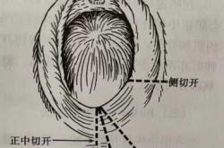 顺产侧切伤口裂开有图片吗
