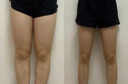 剖腹产后如何瘦腿效果好