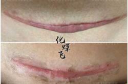 剖腹产疤痕对孩子有影响吗