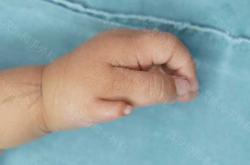 新生儿手术注意什么