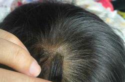 哪里能找到婴儿头皮屑图片