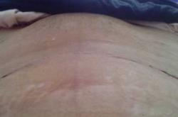 剖腹产42天后又出血怎么回事