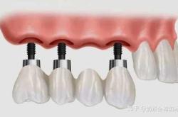 女性种植牙影响备孕吗