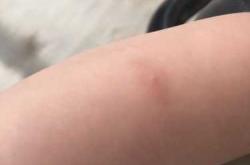 婴儿身上长小疙瘩怎么办