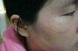 产后皮炎应该怎么办