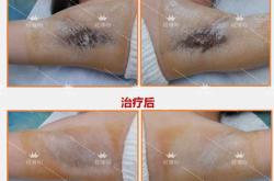 产后腋臭为何会加重