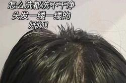 产后头发变油是什么原因