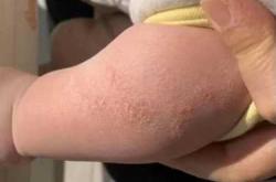 婴儿长湿疹是什么原因