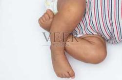 新生儿腿瘦正常吗