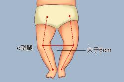 正确婴儿腿纹图片怎么找