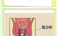 有外痔疮可以顺产吗