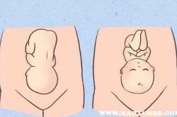 巧囊怀孕是否能顺产