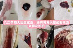 完全性前置胎盘剖腹产风险大吗