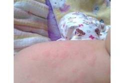 小孩尿不湿过敏有何图片表现