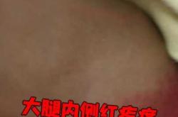 产后大腿内侧长疙瘩咋回事