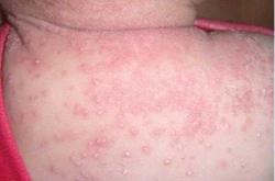 婴儿皮肤颗粒是怎么回事