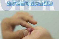 婴儿血管瘤怎么治疗