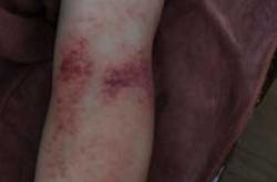 产后哺乳期能刮痧吗