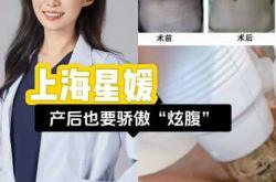 产后如何去除妊娠纹