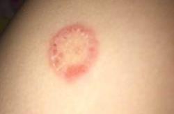 婴儿身上长癣图片咋看