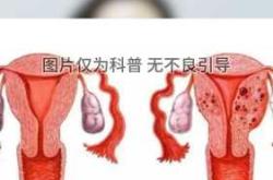 腺肌症经期延迟如何备孕