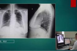 胸片对备孕人群有影响吗