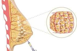 产后乳房小硬疙瘩怎么办