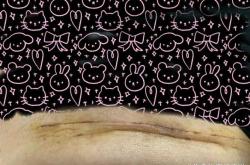 剖腹产刀口上面有硬块是怎么回事