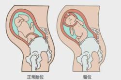 横位剖腹产有何危险