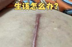 剖腹产后有囊肿该怎么办