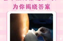 剖腹产不打麻药视频是真的吗