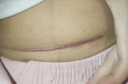 河北生殖妇产剖腹产多少钱