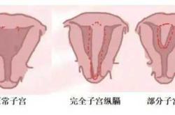 纵隔子宫流产后啥状况