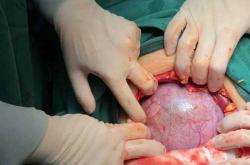 剖腹产产后大出血个案是啥样