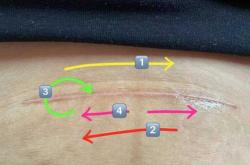 剖腹产疤痕如何修复