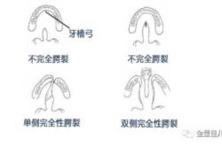 腭裂宝宝辅食怎么添加