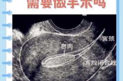 子宫后位长息肉怎么备孕