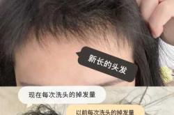 产后掉东西是怎么回事