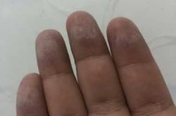 剖腹产播种网如何选择