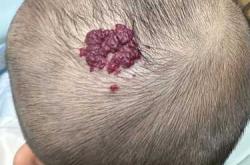 新生儿血管瘤因何而生