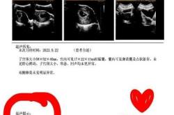 平扫ct对备孕有影响吗