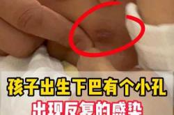 新生儿小下颌有哪些图片