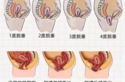 如何看懂产后子宫图