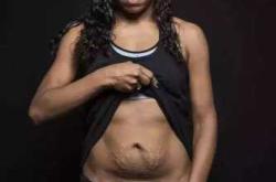 剖腹产一年后刀口为何会痒