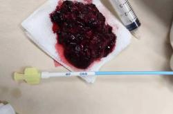 产后血栓一般多久会好