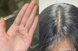 产后脱发还长白头发怎么办