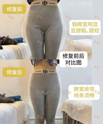 产后耻骨分离能自愈吗-第1张图片