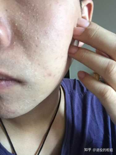产后脸上脱皮如何有效解决-第1张图片